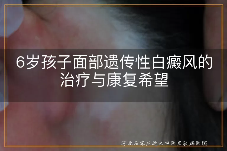 遗传性白癜风,6岁孩子,面部治疗,康复希望,多样化治疗方案,家长关怀