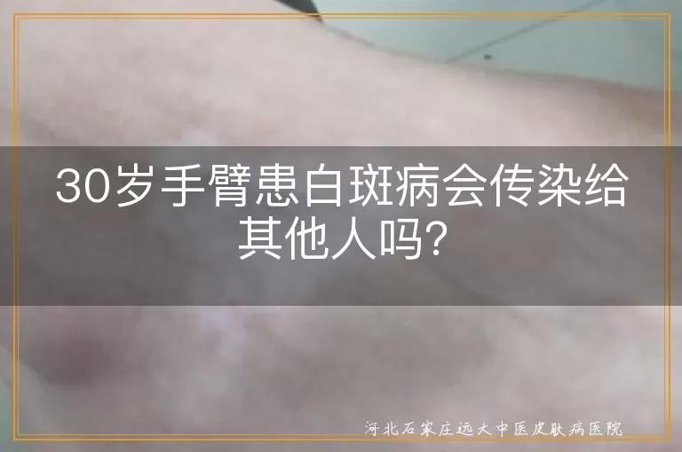 白斑病,白癜风,传染,遗传,自身免疫,环境因素,治疗,理解支持