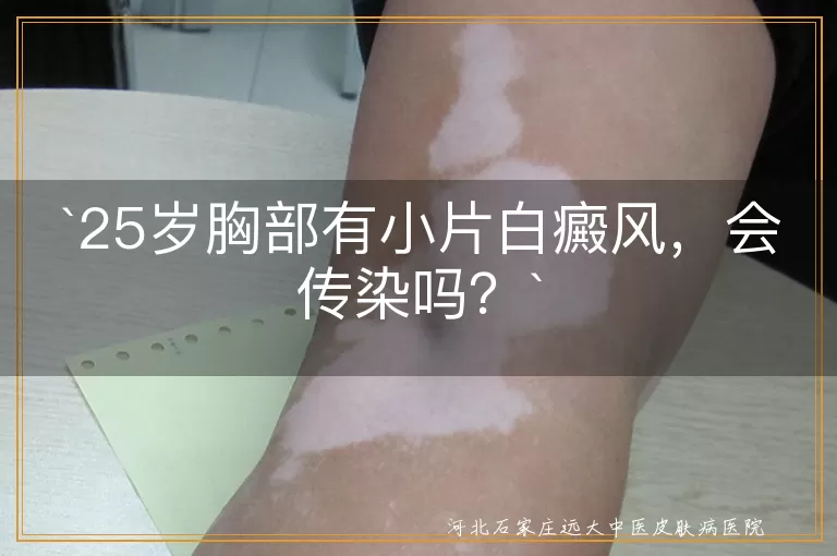 白癜风,传染,色素脱失,免疫系统,治疗