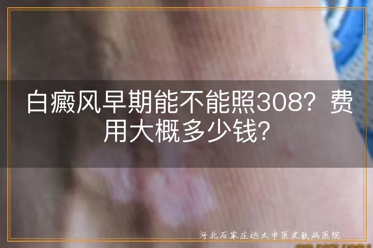 白癜风早期,照308激光,治疗费用,白斑面积,医院级别,治疗次数,注意事项