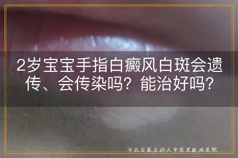 白癜风,遗传,传染,治疗,2岁宝宝,手指白斑