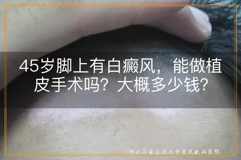 白癜风,植皮手术,费用,治疗选择,复发风险