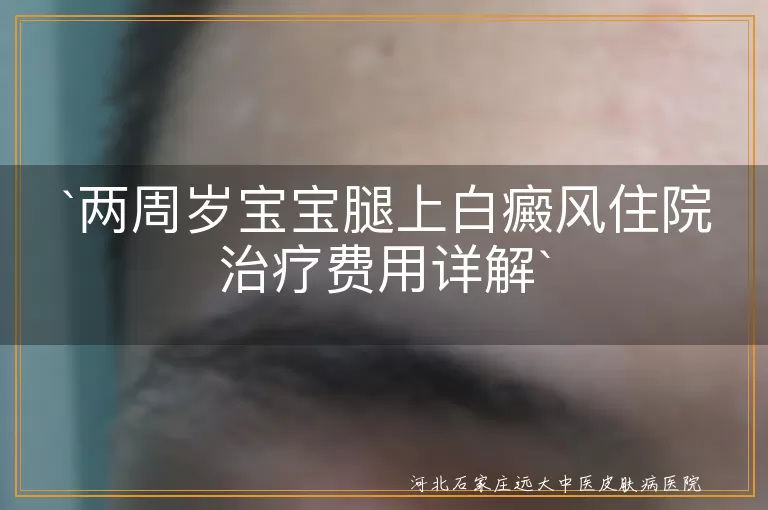 白癜风,两周岁宝宝,治疗费用,病情严重程度,治疗方法,医院级别,医疗保险,日常护理