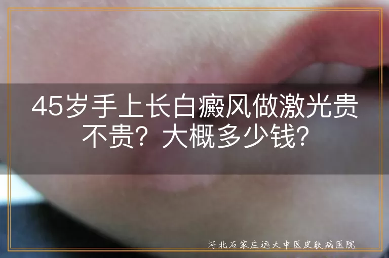 白癜风,激光治疗,费用,病情严重程度,治疗面积,医院等级,地区经济水平,308准分子激光