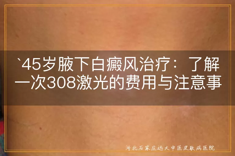 白癜风,308激光治疗,费用,医院级别,地区差异,治疗设备,护理,防晒,复查