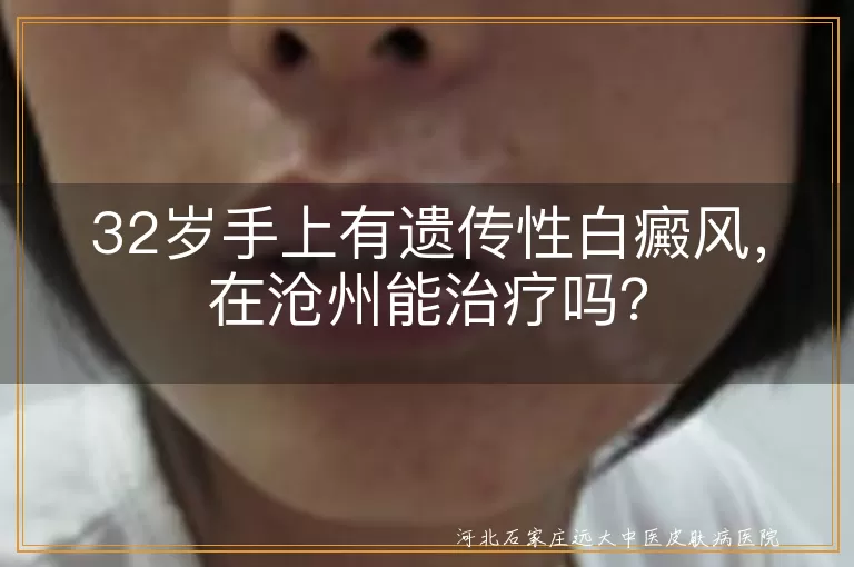 遗传性白癜风,沧州治疗,药物治疗,光疗,手术治疗,生活调理,坚持治疗,谨慎用药,皮肤护理,保持良好心态