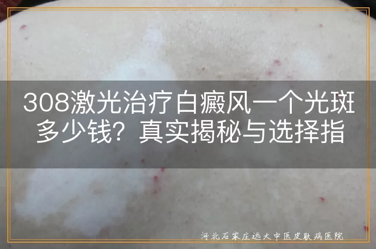 308激光治疗,白癜风,光斑费用,医院选择,护理建议
