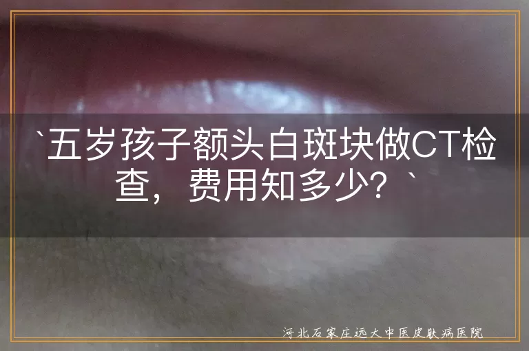 皮肤CT检查,费用,医院等级,地区差异,检查仪器,具体病情,白斑块,孩子健康