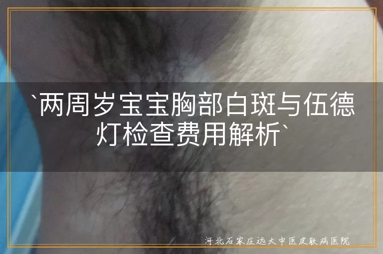 伍德灯检查,白斑,白癜风,费用,两周岁宝宝,皮肤病