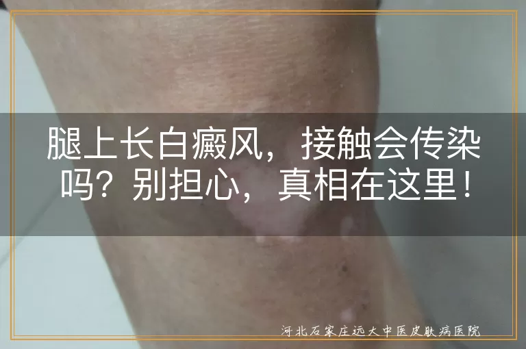 白癜风,传染性,自身免疫性疾病,理解与支持,治疗方案