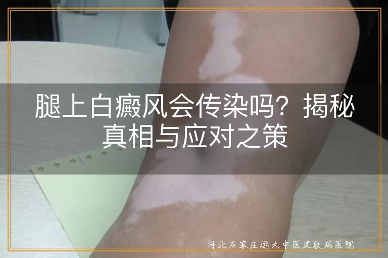 白癜风,传染,病因,治疗,心态调整,日常护理