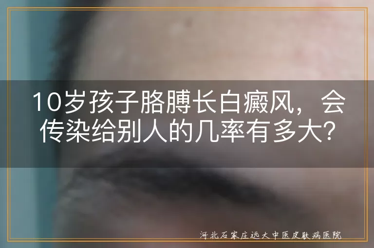 白癜风,传染,遗传,自身免疫,治疗,心理关怀,日常防护