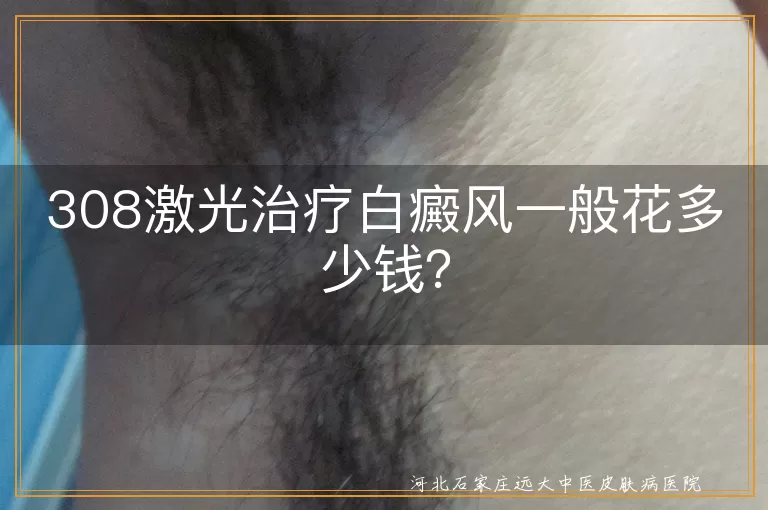 308激光治疗,白癜风,治疗费用,病情严重程度,医院级别,地区经济水平
