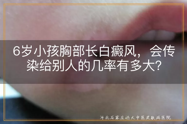 白癜风,不传染,儿童,日常护理,心理支持,遗传因素,环境因素,免疫功能紊乱
