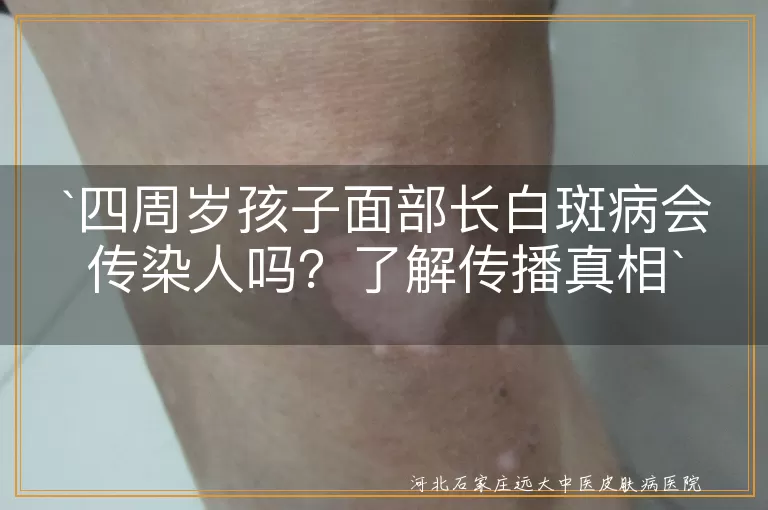 白斑病,白癜风,传染性,儿童,花斑癣,就医,治疗,护理