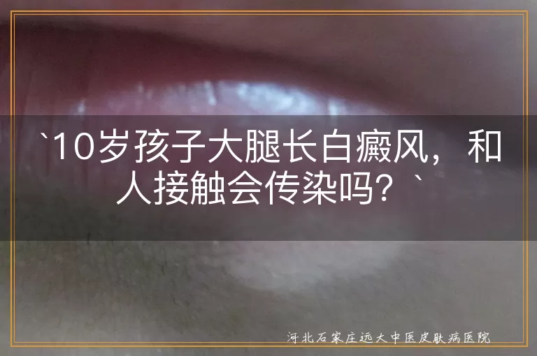 白癜风,10岁孩子,大腿,传染,黑色素细胞,治疗,生活照顾,心理健康