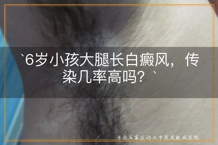 白癜风,传染,儿童,治疗,护理,遗传,环境,微量元素,外伤,免疫功能紊乱