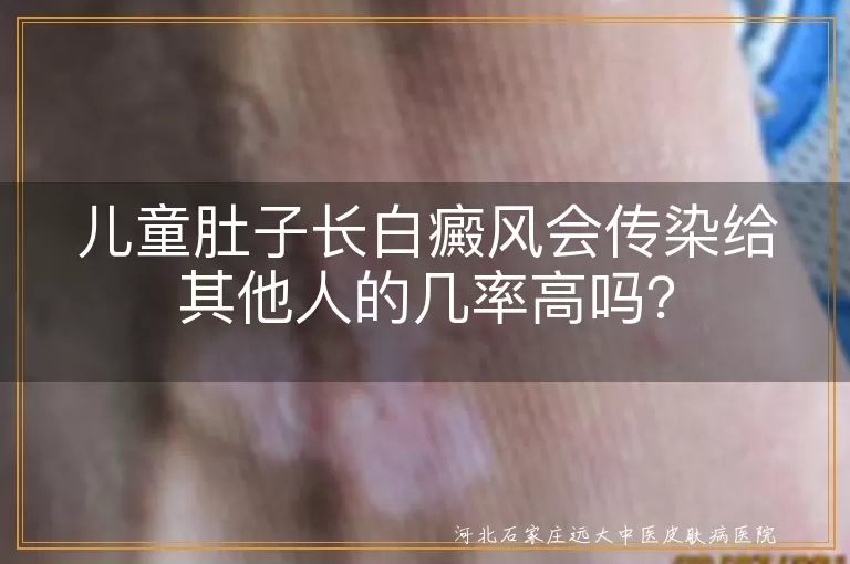 白癜风,儿童,传染,遗传,治疗,护理,心理健康