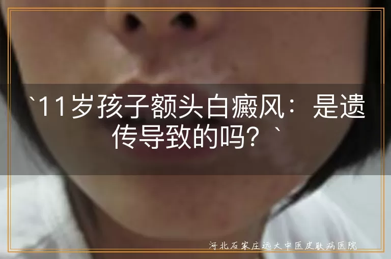 白癜风,遗传,自身免疫,精神因素,环境因素,治疗方法,心理疏导,日常护理
