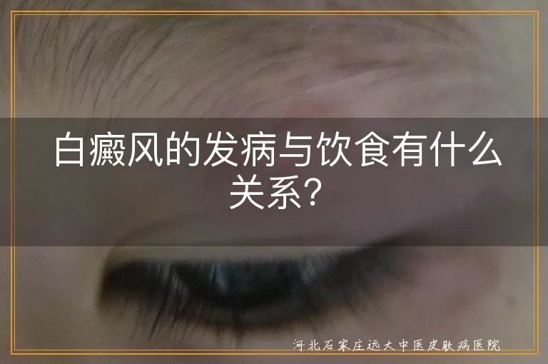 白癜风,饮食,发病原因,遗传因素,自身免疫,均衡饮食,刺激性食物,维生素C