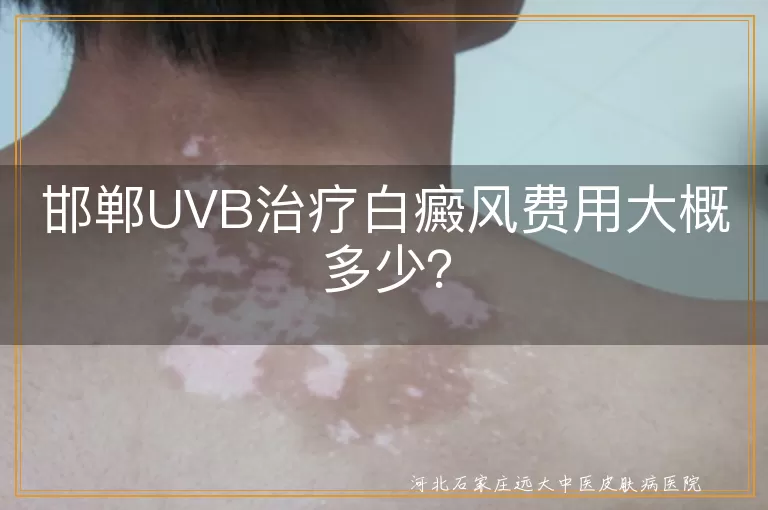 邯郸,UVB治疗,白癜风,费用,治疗效果
