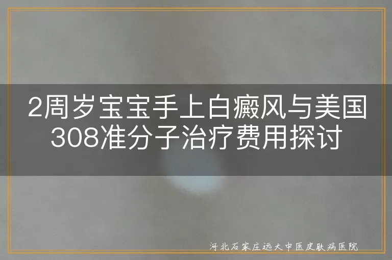 白癜风,2周岁宝宝,美国308准分子激光,治疗费用,病情严重程度,治疗周期,医院级别,地区差异,医疗保险