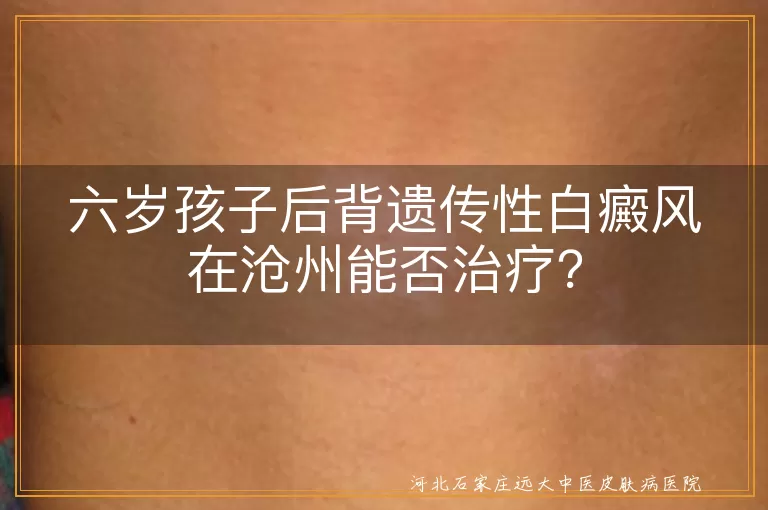 沧州,儿童白癜风,治疗,光疗,药物治疗,心理支持,个性化方案