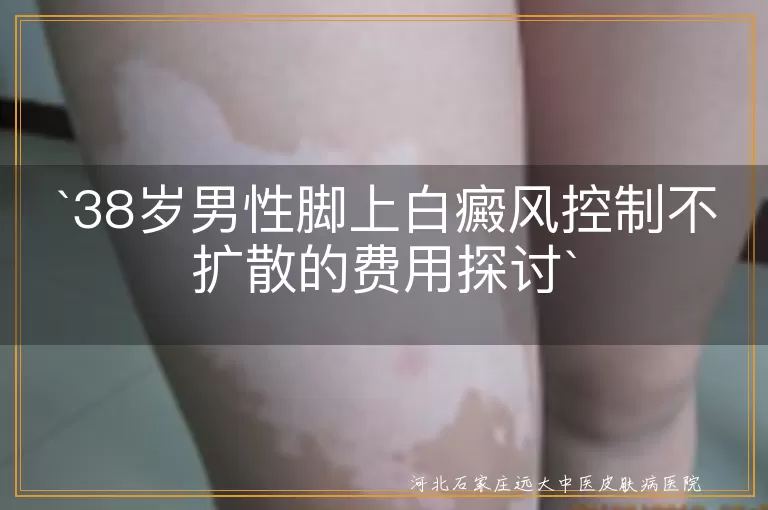 白癜风,治疗费用,病情严重程度,治疗方法,地区消费水平,正规公立医院