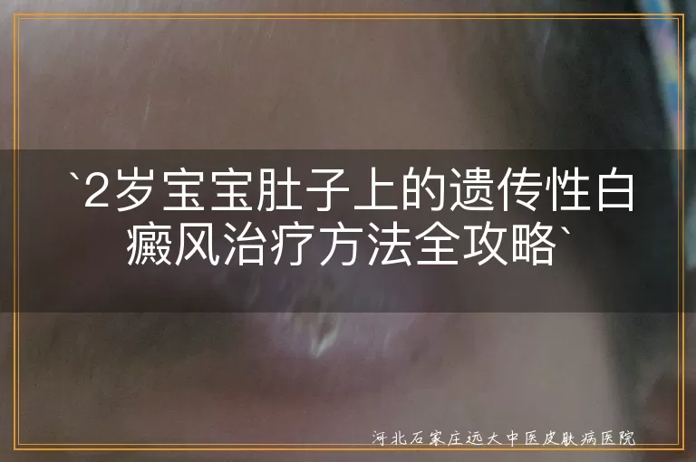 遗传性白癜风,2岁宝宝,治疗方法,一般治疗,药物治疗,物理治疗,手术治疗,日常护理