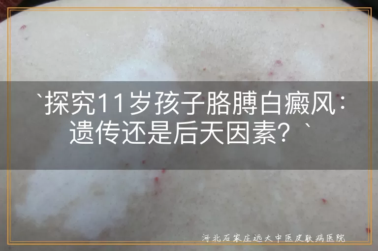 白癜风,遗传,后天因素,太阳暴晒,外伤刺激,精神因素,饮食不当
