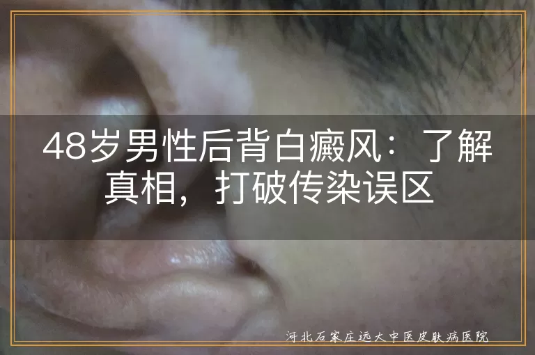 白癜风,不传染,治疗,生活习惯,支持理解