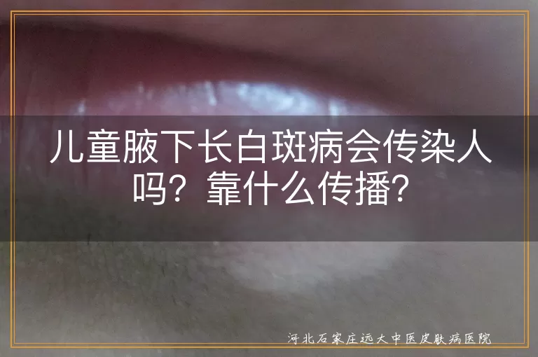 儿童腋下白斑病,传染性,白癜风,白色糠疹,花斑癣,遗传因素,自身免疫反应,环境因素