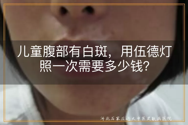 儿童白斑,伍德灯检查,价格,诊断,治疗