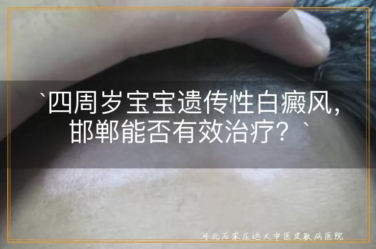 遗传性白癜风,邯郸治疗,四周岁宝宝,个性化治疗方案,家长配合