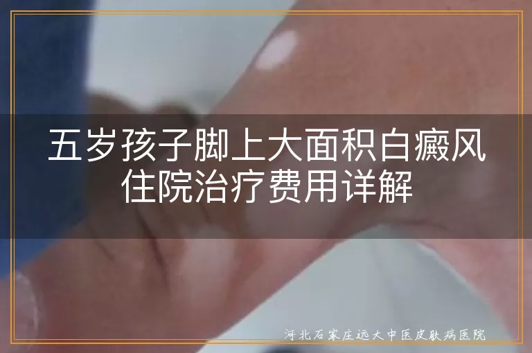白癜风,治疗费用,激光治疗,手术治疗,医疗保险,财务规划