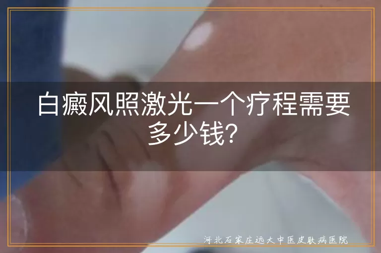 白癜风,激光治疗,费用,疗程,影响因素