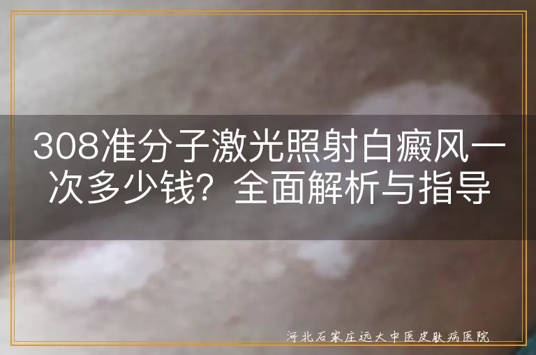 308准分子激光,白癜风,治疗费用,影响因素,选择建议
