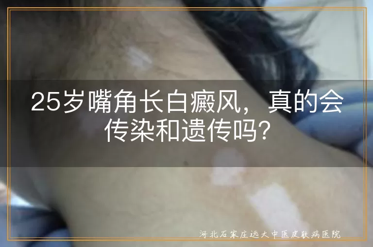 白癜风,传染,遗传,自身免疫,精神因素,日常护理,治疗方法
