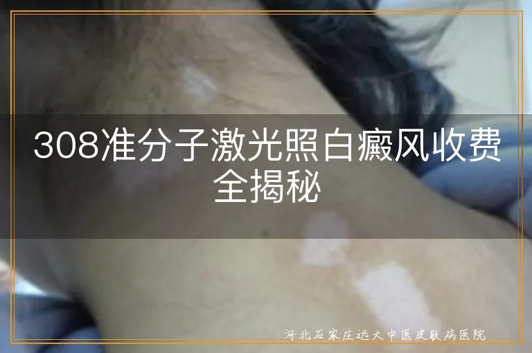 308准分子激光,白癜风,收费,光斑,治疗次数,地区,医院等级,病情严重程度,节省费用