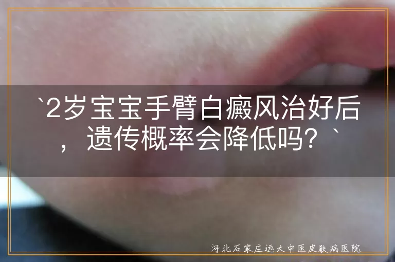 白癜风,遗传概率,治疗,环境因素,预防,关爱支持