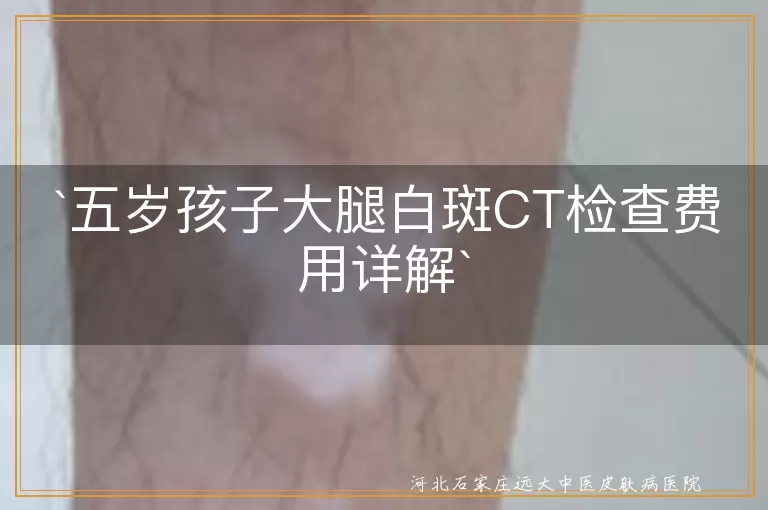 五岁孩子,大腿白斑,皮肤CT检查,费用,白癜风,诊断,治疗