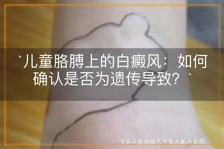 儿童白癜风,遗传,家族病史,专业检查,科学治疗,心态调整,家庭支持