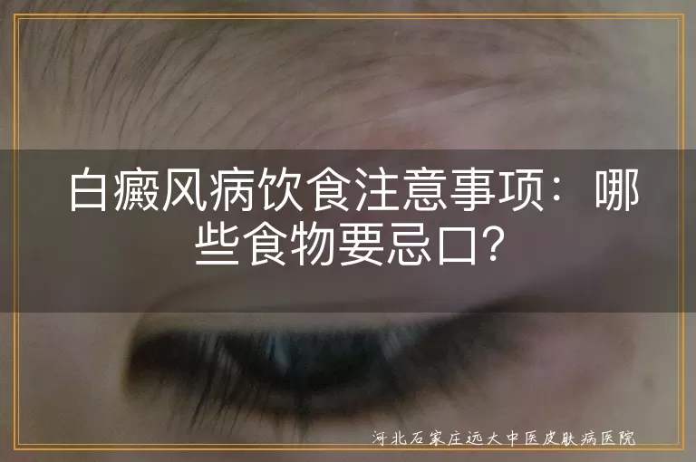 白癜风,饮食注意事项,忌口食物,维生素C,刺激性食物,戒酒戒烟,海鲜发物,饮食均衡,营养摄入,新陈代谢