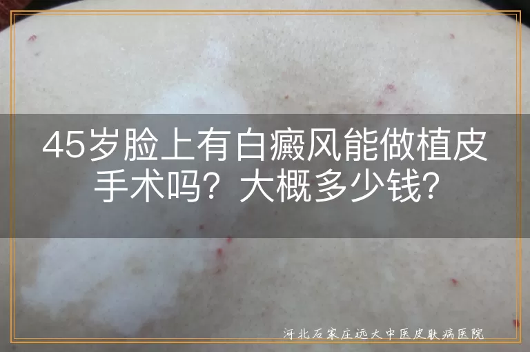 白癜风,植皮手术,表皮移植,手术费用,面部白斑