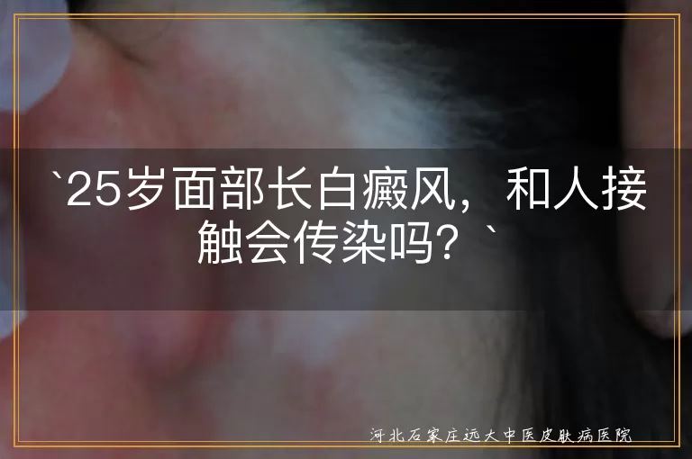 白癜风,传染,病因,治疗,日常生活注意事项