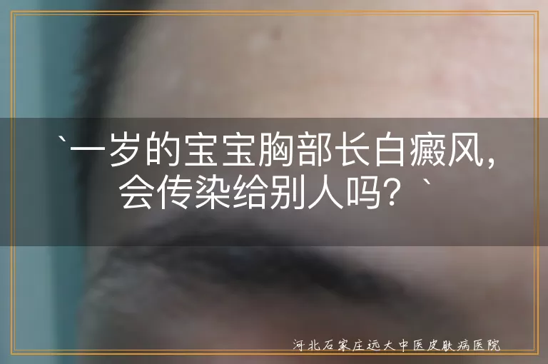白癜风,传染性,宝宝,遗传,自身免疫,治疗,预防