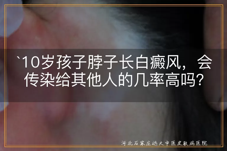 白癜风,传染,遗传,治疗,生活环境,饮食习惯