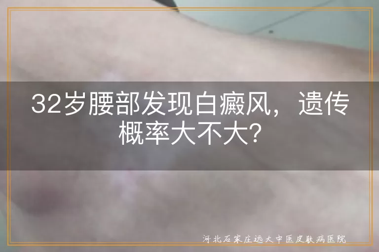 白癜风,遗传概率,治疗,生活习惯,心态调整