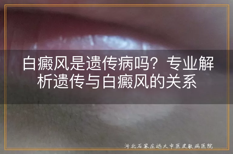 白癜风,遗传病,遗传倾向,多基因遗传,环境因素,治疗