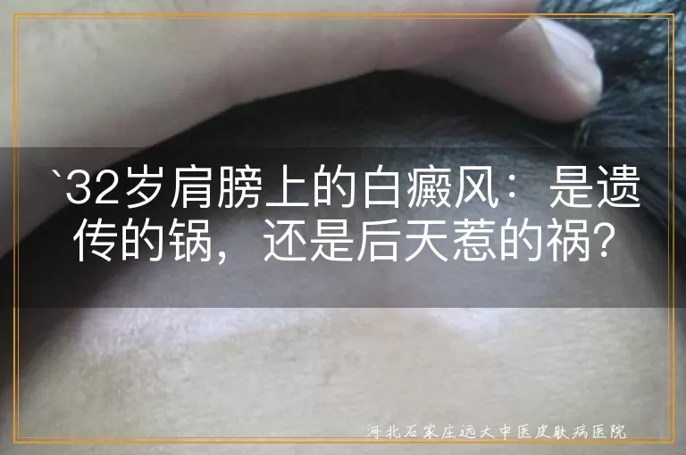 白癜风,遗传因素,后天因素,压力,饮食不规律,环境污染,外伤刺激,预防